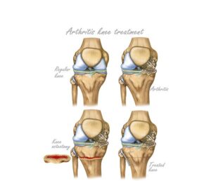 osteotomía de rodilla