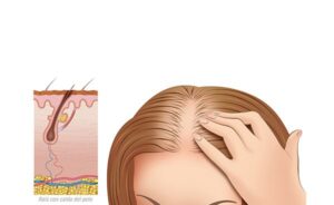 perdida del cabello