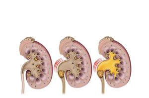 piedra riñon y ureter