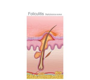 piel con foliculitis