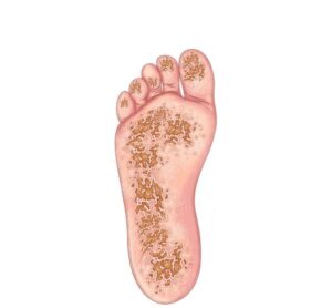 planta del pie con artritis reactiva