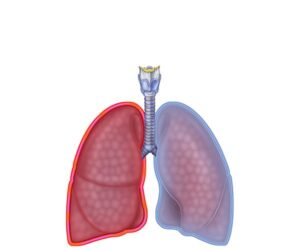 inflamación pleural pulmonar