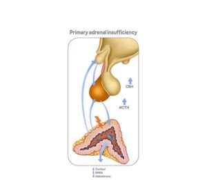 primary adrenal insufficiency