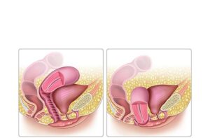 prolapso uterino
