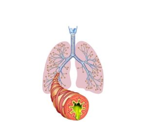 pulmones y bronquitis