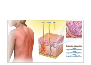 quemadura con rayos uva ,uvb y uvc