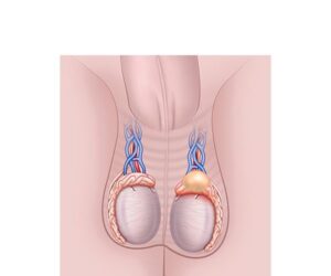 quiste en testiculos