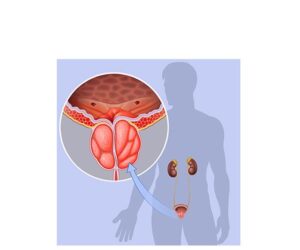 tumor canceroso testicular