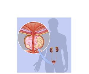 tumor canceroso testicular