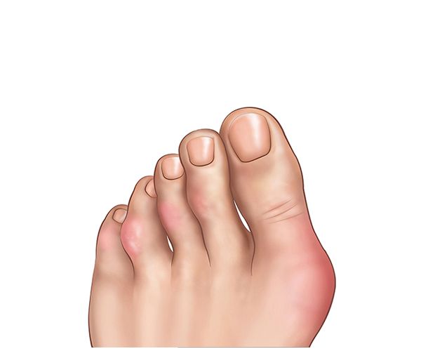 rheumatoid arthritis rheumatoid arthritis