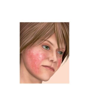 rostro con dermatomiositis