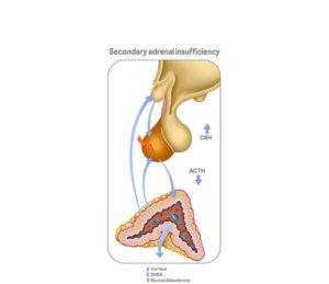 secondary adrenal insufficiency
