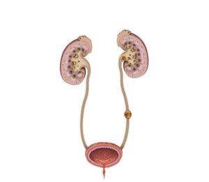sistema renal femenino con calculos