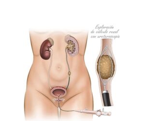 ureteroscopia de cálculos ureterales