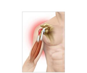 tendinitis de hombro