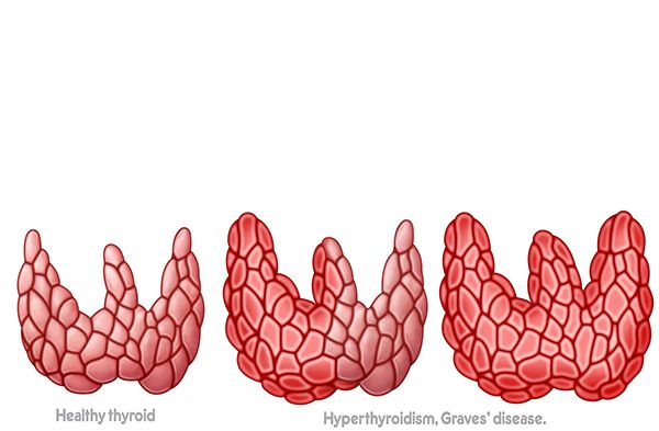 the thyroid in hyperthyroidism the thyroid in hyperthyroidism