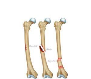 tipos de fracturas 1