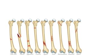 tipos de fracturas óseas