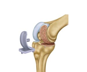 tratamiento artrosis rodilla parcial