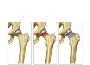tratamiento fractura subcapital del femur