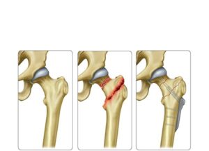 tratamiento fractura intertrocantéreas