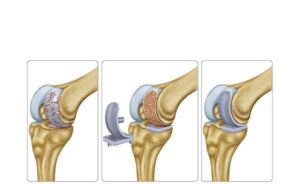the knee joint replacement