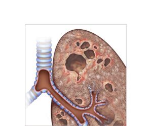 tuberculosis infección pulmonar