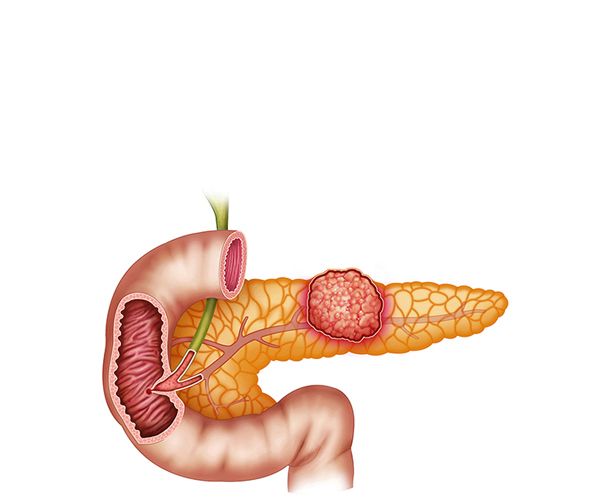 tumor pancreas tumor pancreas