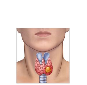 tumor tiroides