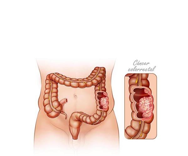 tumor cancerigeno de colon tumor cancerigeno de colon