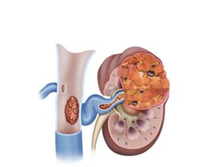tumor canceroso avanzado