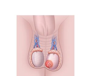 tumor canceroso en testiculos