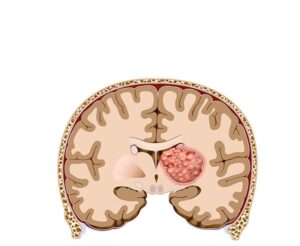 tumor cerebral