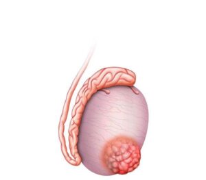 tumor de testiculo