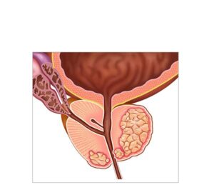 tumor maligno de próstata