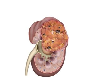 tumor riñon