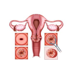 tumor y tratamiento en cervix