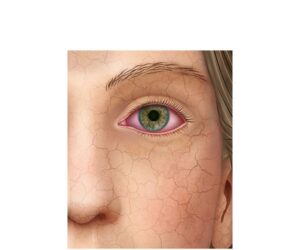 un rostro en sindrome de sjögren