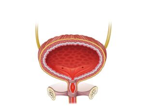 vejiga femenina cistitis
