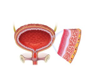 vejiga femenina con cistitis