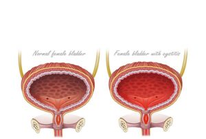 vejiga femenina normal con cistitis