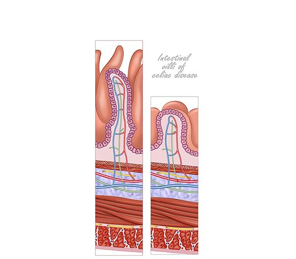 vellosidad intestino delgado en celiaca vellosidad intestino delgado en celiaca