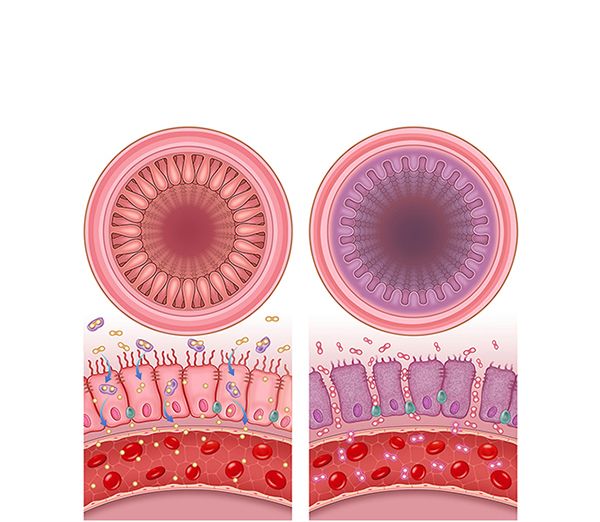 vellosidad normal y celiaca vellosidad normal y celiaca