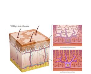addison and autoimmune vitiligo