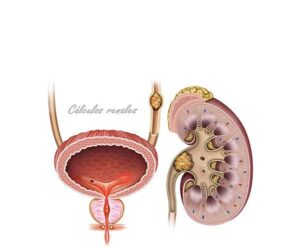 calculo renal