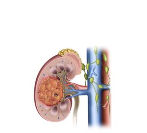 cancer renal estadio 1