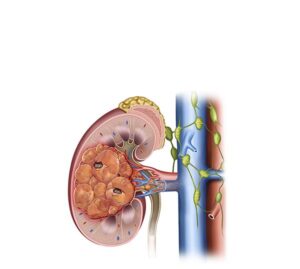 cancer renal estadio 2
