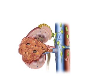 cancer renal estadio 3