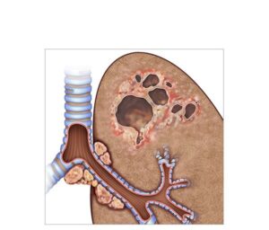 tuberculosis and lung cancer