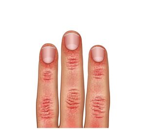 dedos en dermatosis